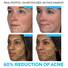 Effaclar Duo Acne Spot Treatment